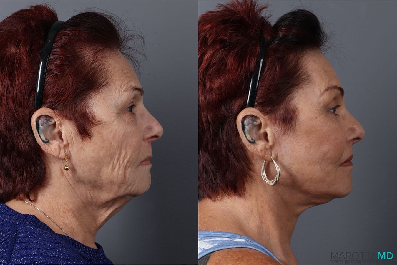 Eyelid Surgery Before & After