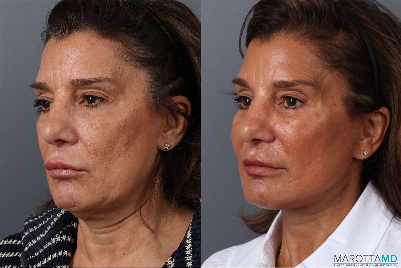 Eyelid Surgery Before & After