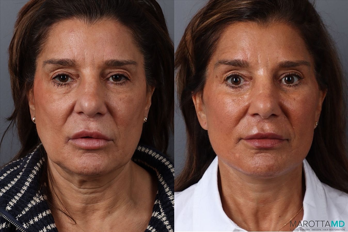 Eyelid Surgery Before & After