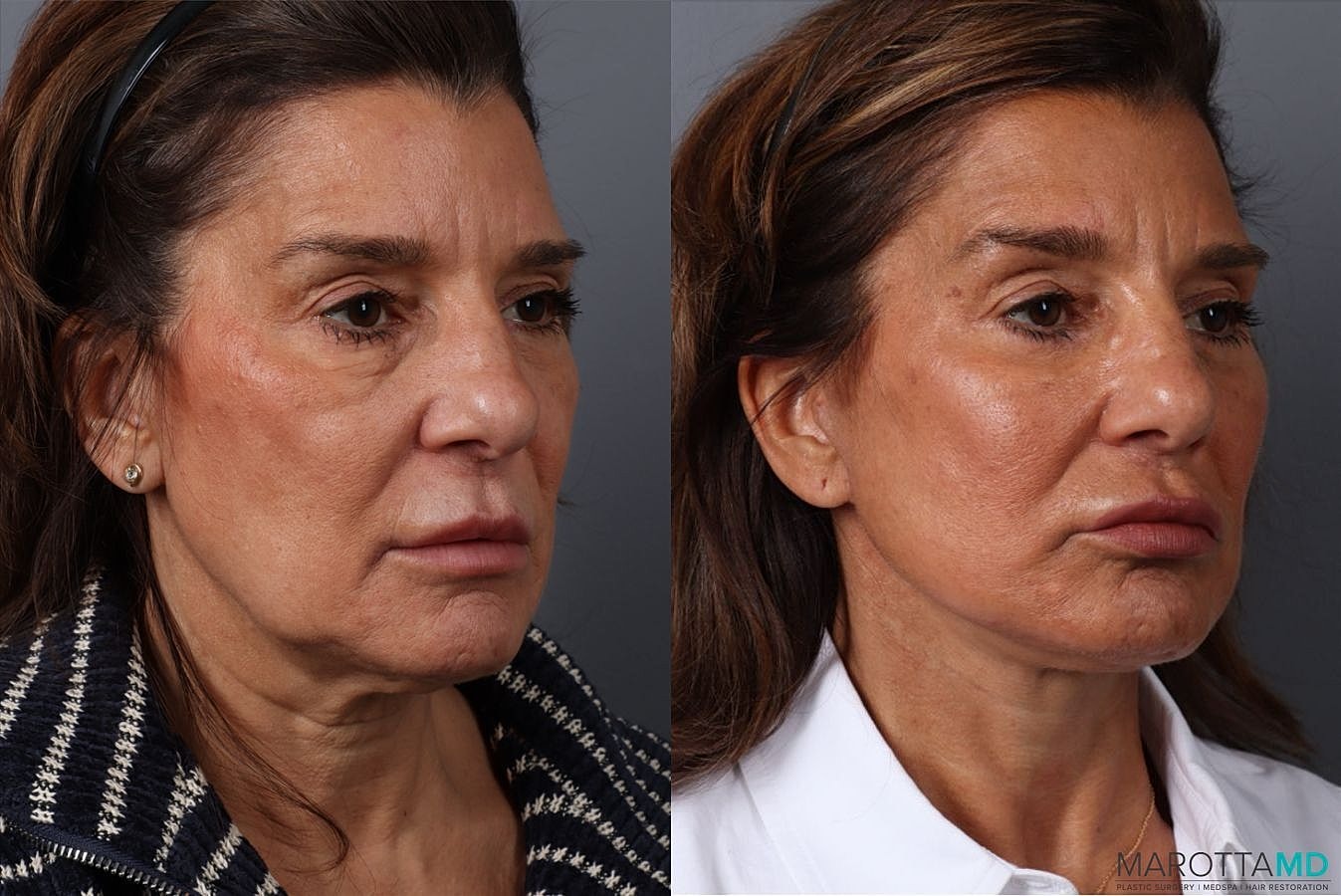 Eyelid Surgery Before & After
