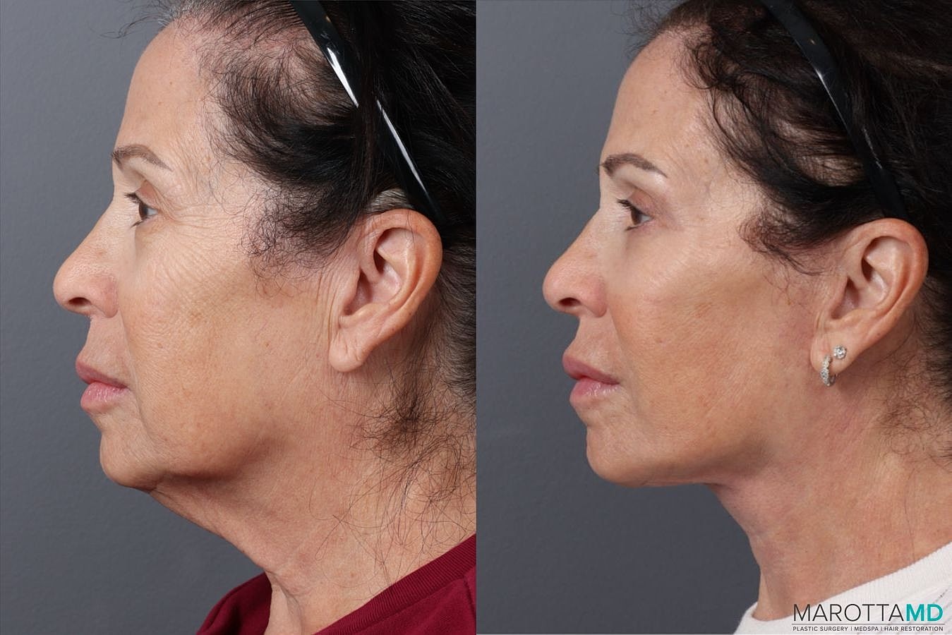 Eyelid Surgery Before & After