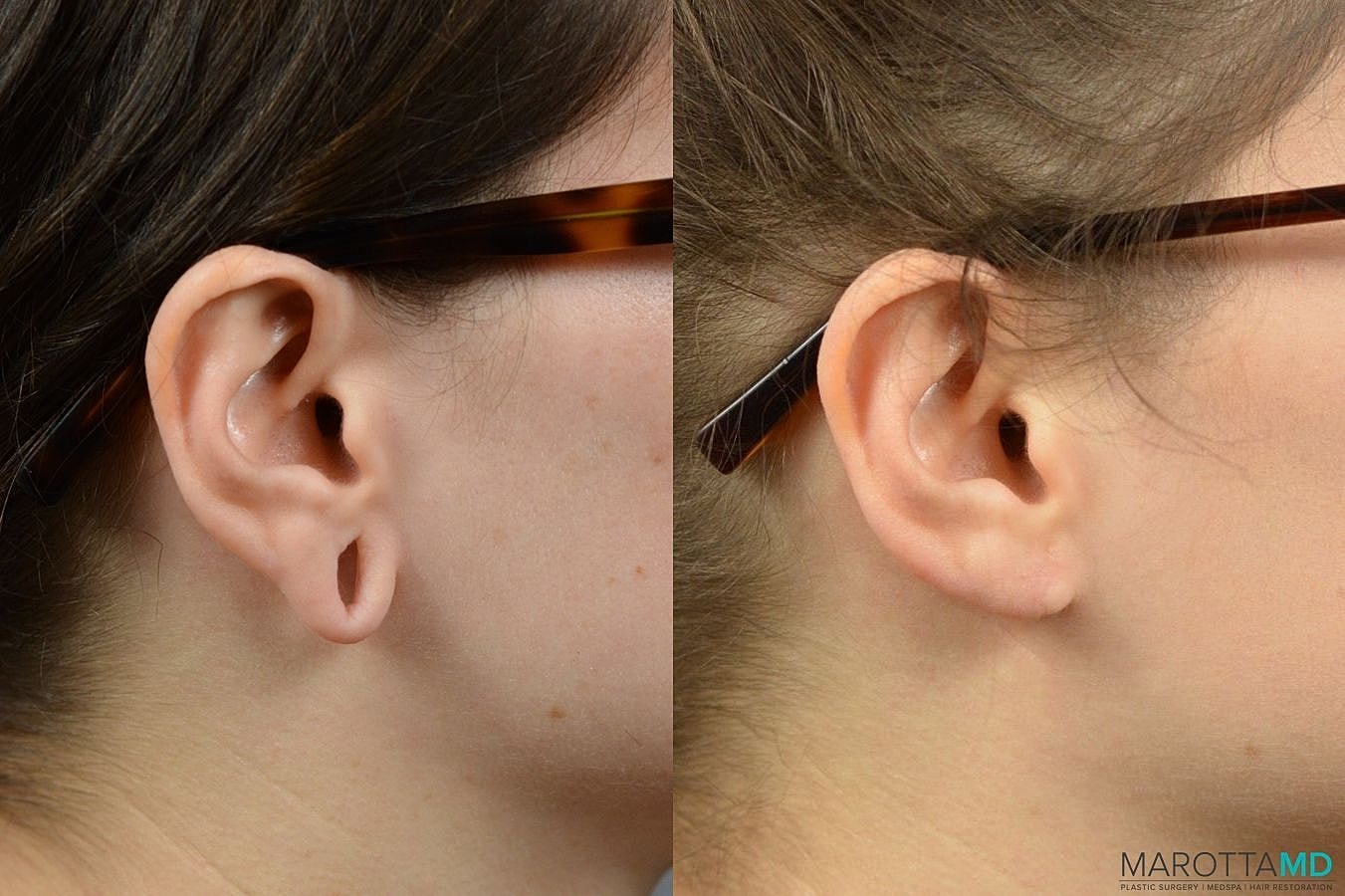 Earlobe Surgery Before & After