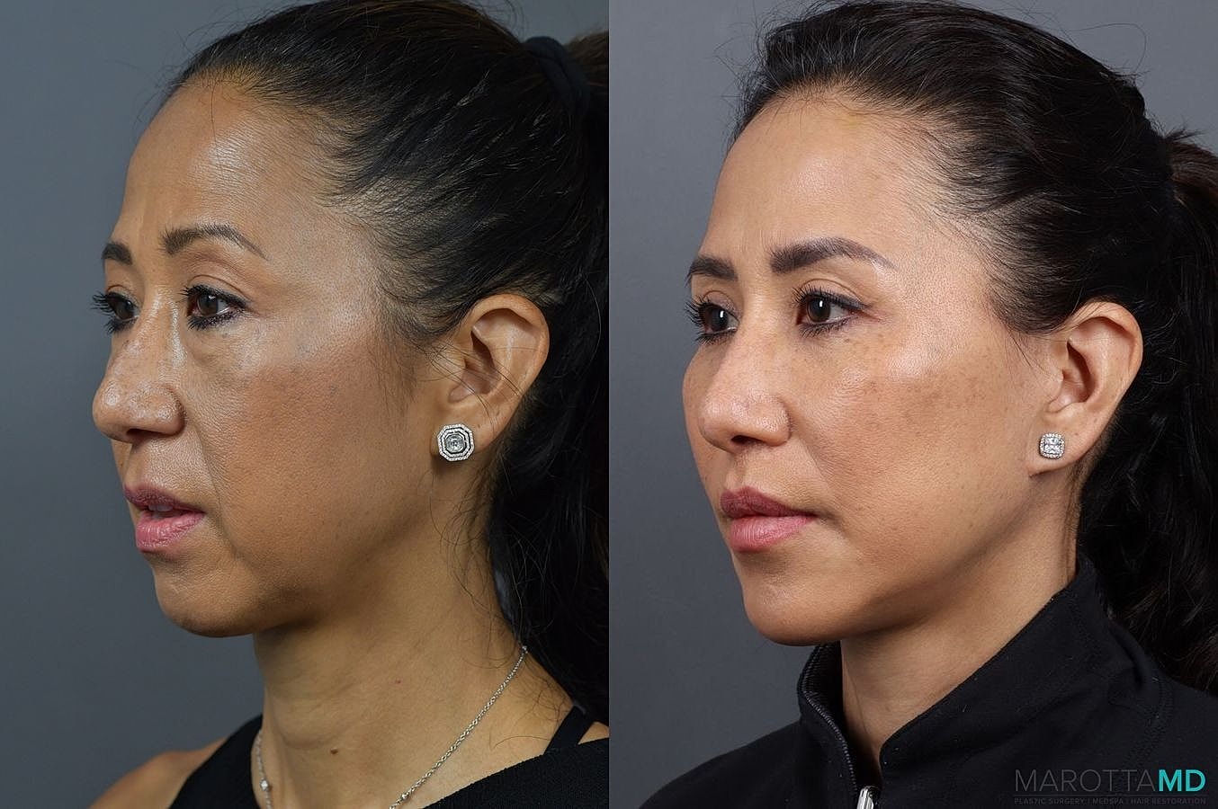 Chin Implant Before & After