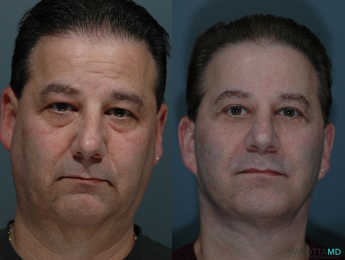 Chin Implant Before & After