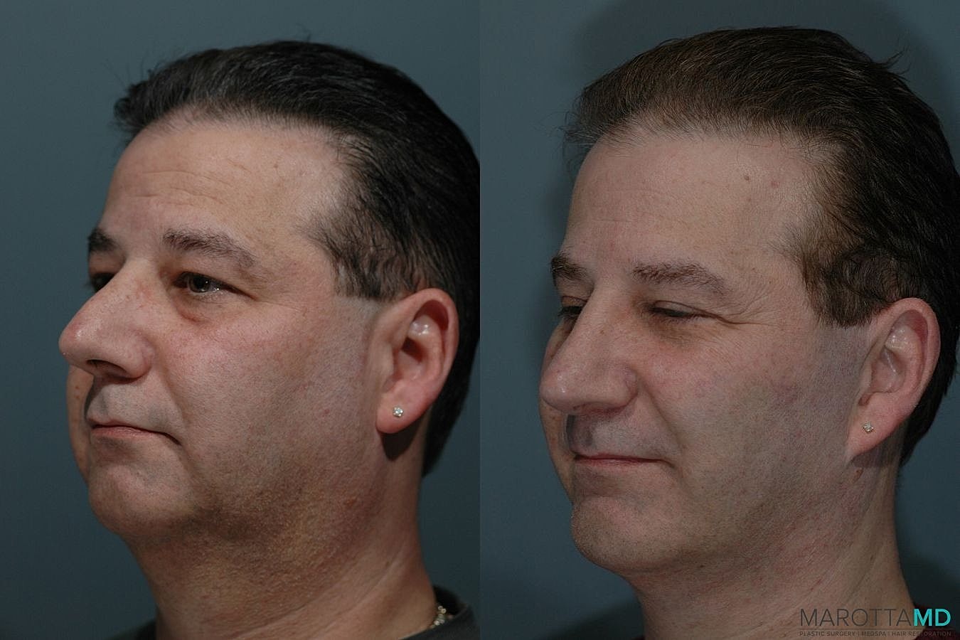 Chin Implant Before & After