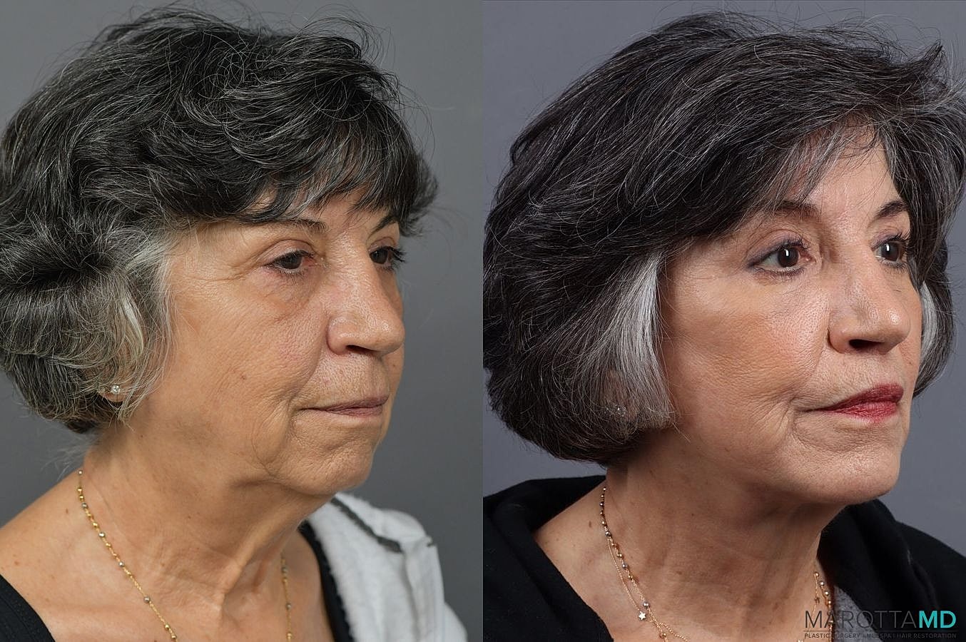 Chin Implant Before & After