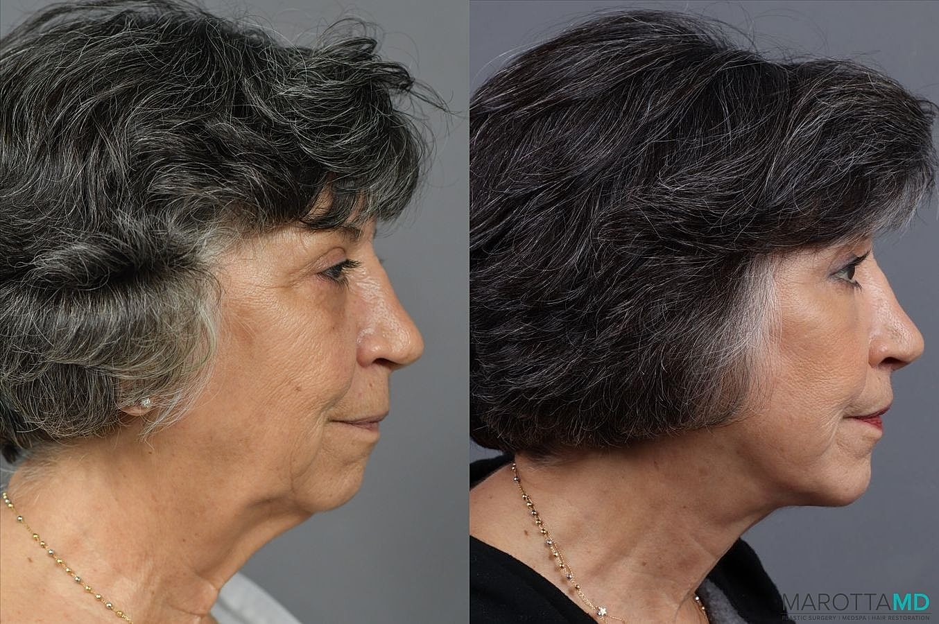 Chin Implant Before & After