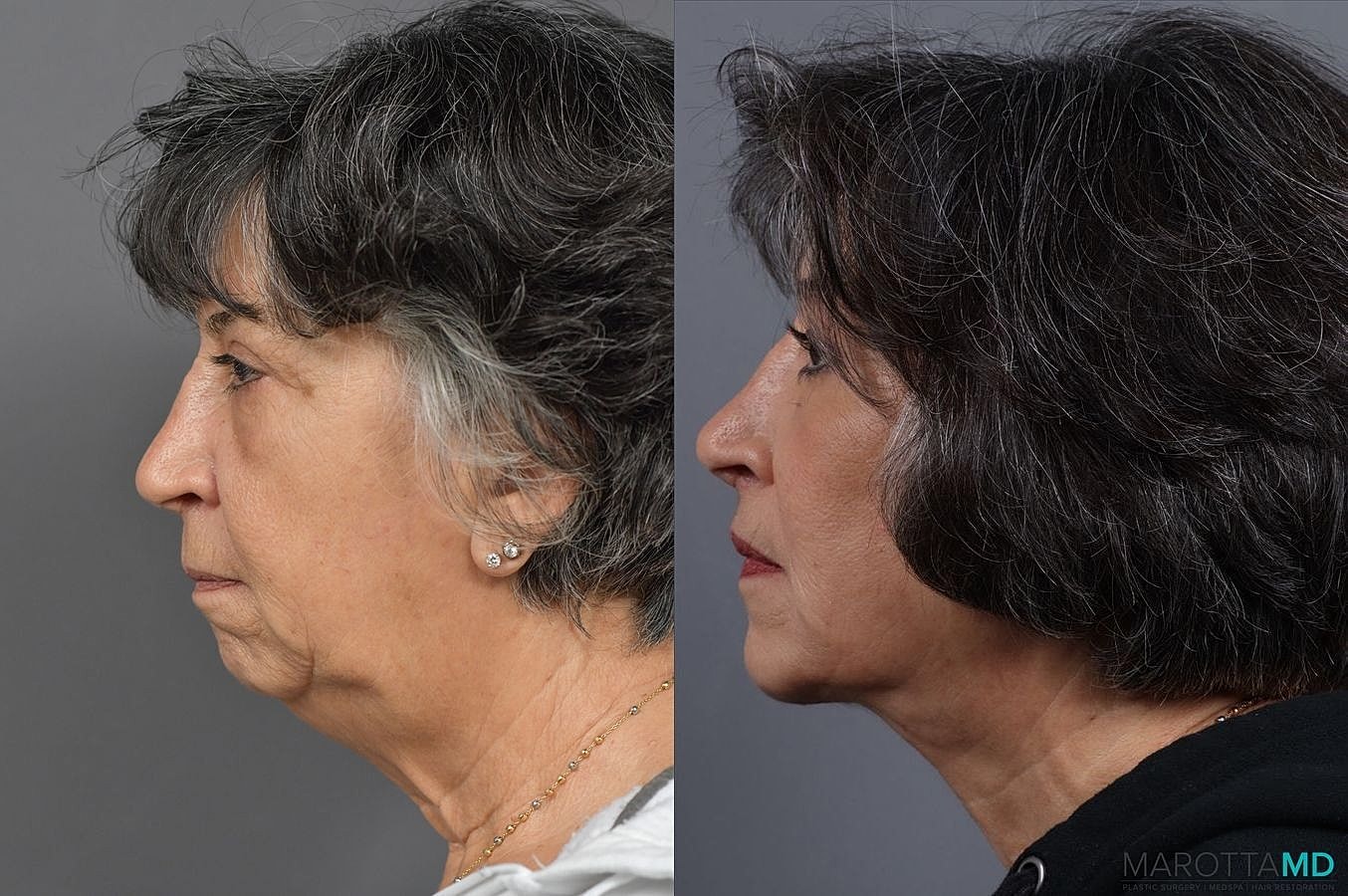 Chin Implant Before & After