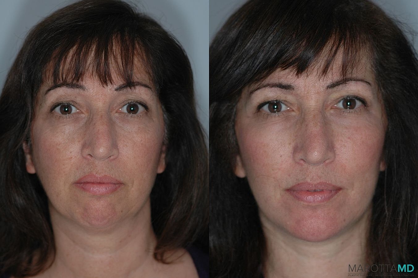 Chin Implant Before & After