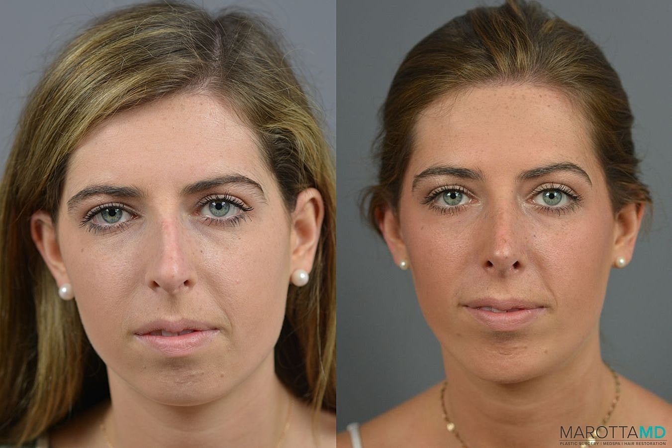 Chin Implant Before & After