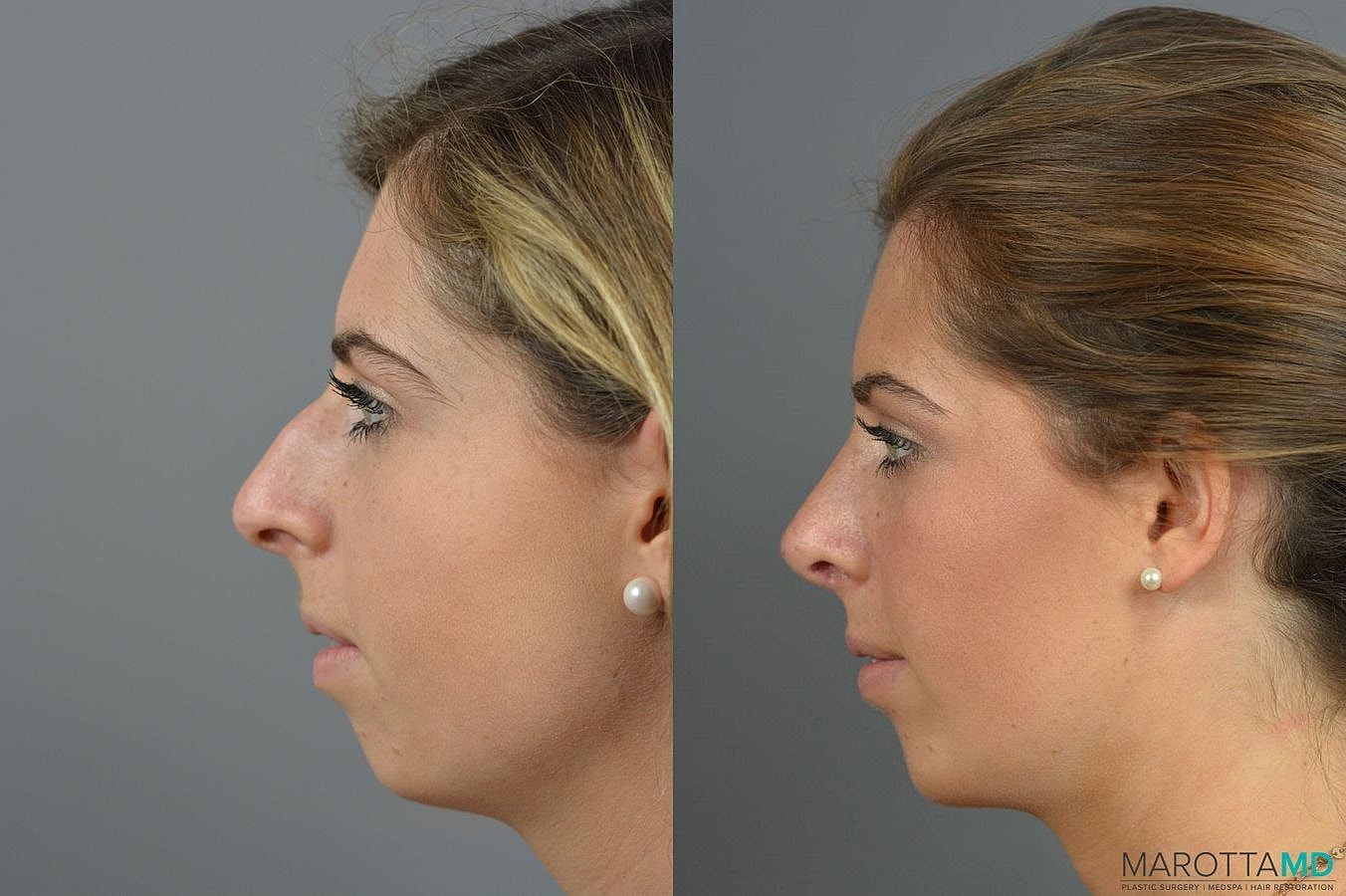 Chin Implant Before & After