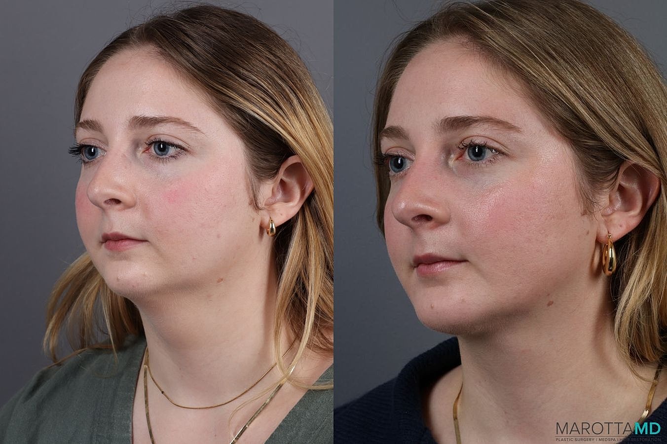 Chin Implant Before & After