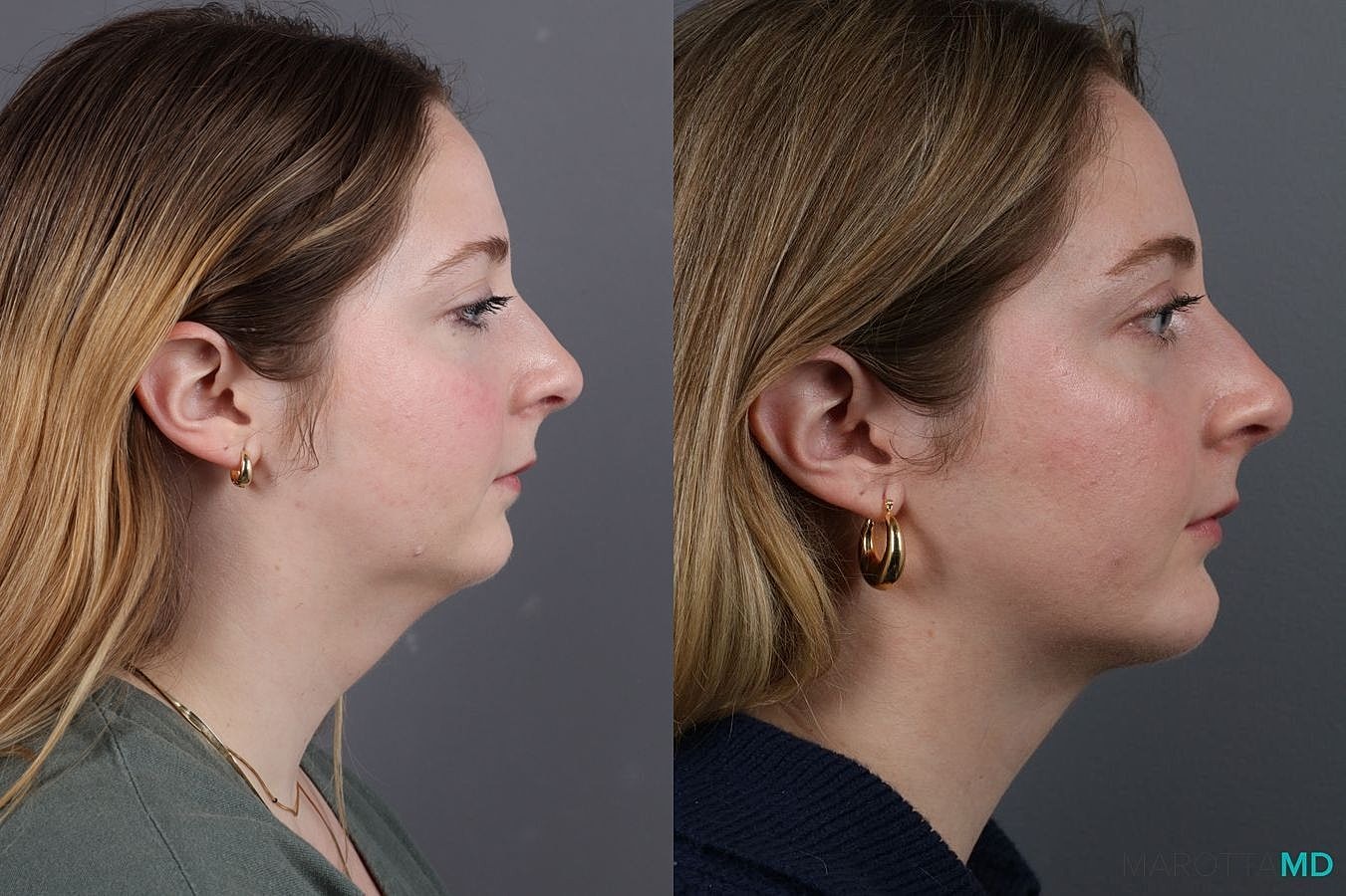 Chin Implant Before & After
