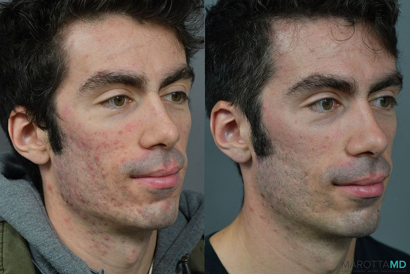 Microneedling Before & After