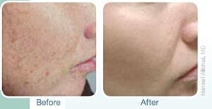 ipl photofacial before and after